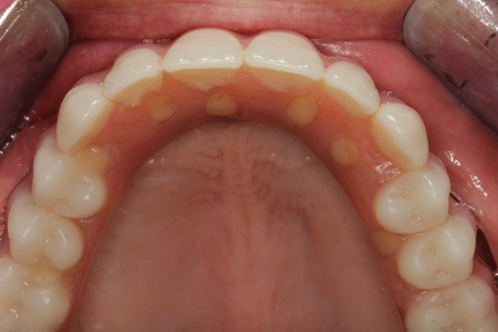 Upper And 
      Lower Partial Dentures Santa Cruz CA 95060